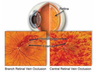 Dedicated Retinal Services for Circulation Problems