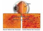 Dedicated Retinal Services for Circulation Problems