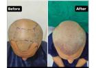 Hair Transplant in Baner - The Aesthetic Hub