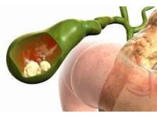 Trusted Choice for Gall Stone Surgery in Kolkata