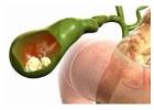 Trusted Choice for Gall Stone Surgery in Kolkata
