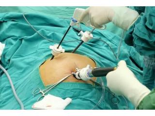 Laparoscopic Gallstone Surgery Options in Kolkata