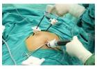 Laparoscopic Gallstone Surgery Options in Kolkata