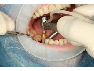 Best Tooth Implant Process Guide for a Smooth Treatment