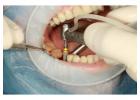 Best Tooth Implant Process Guide for a Smooth Treatment