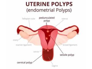 Hysteroscopy Procedure in Delhi - Dr Rhythm Gupta