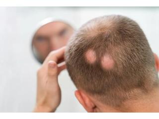 Expert Alopecia Care | Alopecia Treatment Center Lawrenceville GA