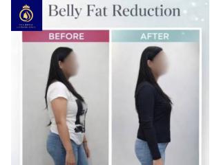Fat Reduction in Thane – Effective Solutions by DNA Royal.