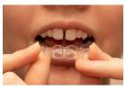 Best Aligners for Gap Teeth for a Straighter Smile