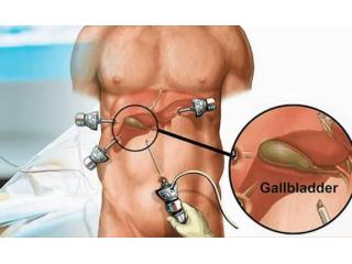 Affordable Gallbladder Stone Surgery Packages in Kolkata