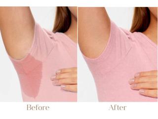 Excessive Sweating Treatment in Delhi