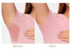 Excessive Sweating Treatment in Delhi