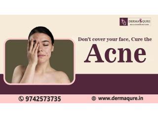 Get Your Clear skin Through Acne Treatment in Bangalore - Dermaqure Skin and Cosmetology Clinic