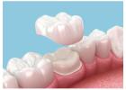 What Is a Dental Crown? Cost, Types & Benefits in Abbotsford