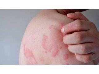 Chronic urticaria research