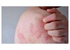 Chronic urticaria research
