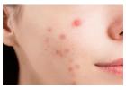 Best Dermatologist in South Delhi