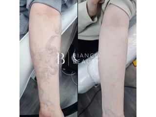 Affordable Tattoo Removal in UK | Professional Laser Tattoo Removal