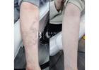 Affordable Tattoo Removal in UK | Professional Laser Tattoo Removal