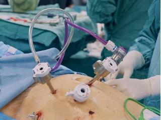 Laparoscopic Gallbladder Surgery in Kolkata – Dr. Purnendu Roy