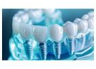All on 4 Dental Implants and Porcelain Veneers for a Confident Somerset Smile 