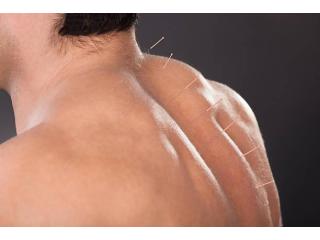 Ease Stiffness With Acupuncture for Tight Back Muscles