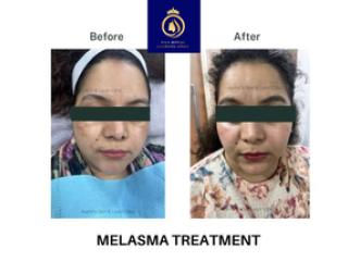Professional Chemical Face Peel in Thane | DNA Royal.