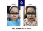 Professional Chemical Face Peel in Thane | DNA Royal.