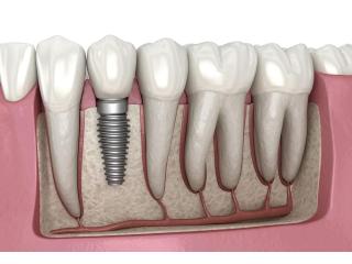 Finding the Right Dentist Near Me in Abbotsford
