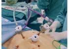 Laparoscopic Gallbladder Surgery in Kolkata – Dr. Purnendu Roy