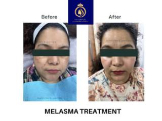 Best Melasma Treatment in Thane – Advanced Skin Care at DNA Royal
