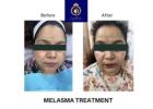 Best Melasma Treatment in Thane – Advanced Skin Care at DNA Royal