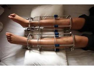 Limb Lengthening Surgeon in Delhi for Specialized Care