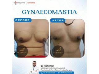 Endoscopic Gynecomastia Surgery in Lucknow – Minimal Scars, Faster Recovery
