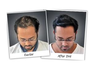 Buy Top Cosmetic Hair Patches at DHI India