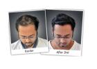 Buy Top Cosmetic Hair Patches at DHI India