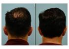 Hair Loss Solutions Dallas | Women’s Thinning Hair Specialist