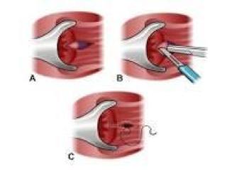 Find the Right Fissure Surgeon in Kolkata for better Treatment