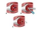 Find the Right Fissure Surgeon in Kolkata for better Treatment  