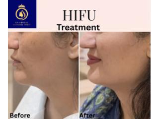 Advanced HIFU Treatment in Thane | Skin Rejuvenation at DNA Royal.