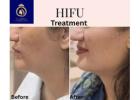 Advanced HIFU Treatment in Thane | Skin Rejuvenation at DNA Royal.