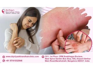 Effective Eczema Treatment for Healthy Skin - Dr. Priya Skin and Hair Clinic