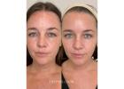 Affordable Facial Treatments Nearby Area: How to Choose