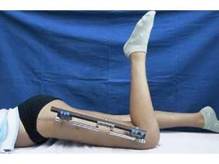 Best Limb Lengthening Surgeon in Delhi for Limb Enhancement