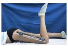 Best Limb Lengthening Surgeon in Delhi for Limb Enhancement