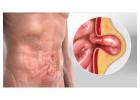 Best Hernia Surgeon in Dum Dum Park for Surgical Treatment