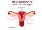 Hysteroscopy Procedure in Delhi - Dr Rhythm Gupta