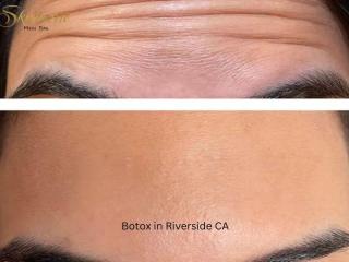 Botox in Riverside CA for a Refreshed Look