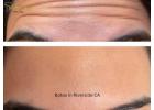 Botox in Riverside CA for a Refreshed Look