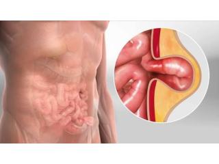Best Hernia Surgeon in Dum Dum Park for Surgical Treatment